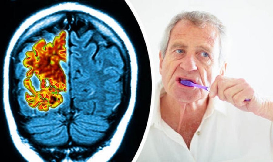 نقش باکتری های دهان در بروز آلزایمر
